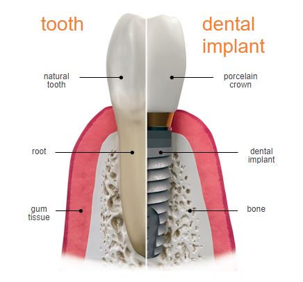 Dental Implants