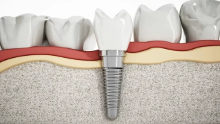 permanent dentures